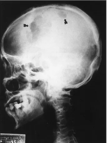 Fig. 3. Case 1：Several tumor cell nests replacing bony trab- trab-eculae. Some tumor cells contain recognizable colloid like subst-ance(arrow)