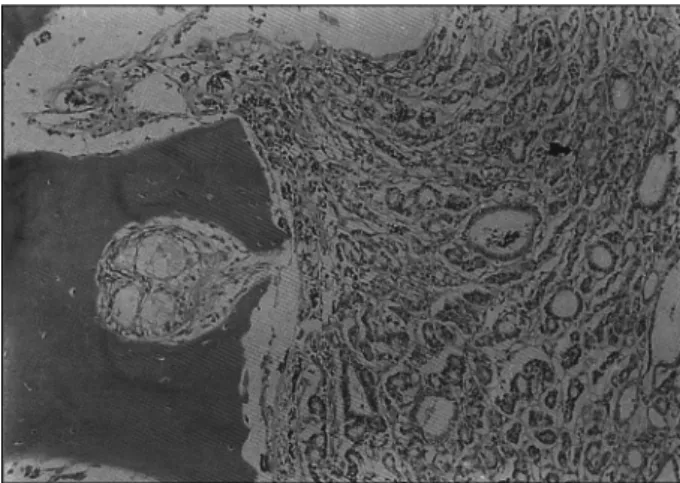 Fig. 6. Case 2：Well differentiated follicles in left side infilt- infilt-rated into adjacent bone