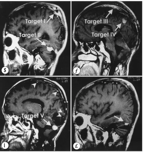 Fig. 2. A：Six months after the reoperation, T1-weighted sagittal MRI scan after the administration of gadolinium demonstrates  that enhancing recurrent tumors(target  Ⅱ) are attached to the right tentorium and intracranial metastasis(tartet  Ⅰ)  to dura on
