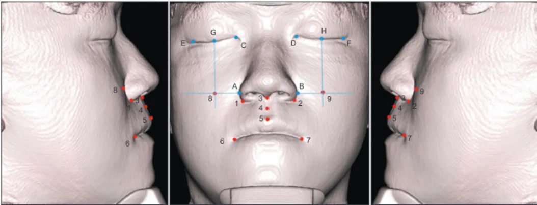 Figure 5. Soft tissue landmarks used in this study. 1 and 2, alar curvature points (right and left); 3, subnasale; 4, soft tis-