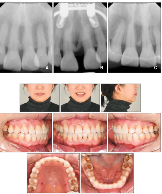 Figure 4. Periapical radio-