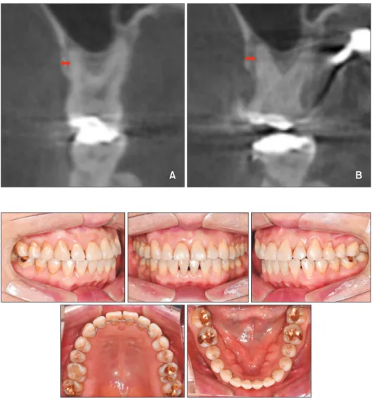 Figure 10. Buccal bone plate 