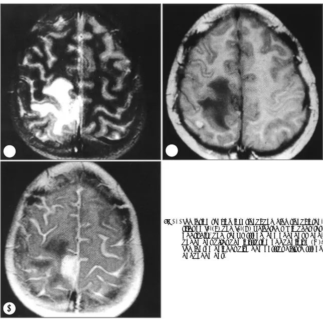 Fig. 1. The lesion shoking low signal and high signal inten- inten-sities on T1-(B) and T2-(A) weighted MR images,  res-pectively, and shows strong homogeneous  enh-ancement after administration of gadolinium(C)