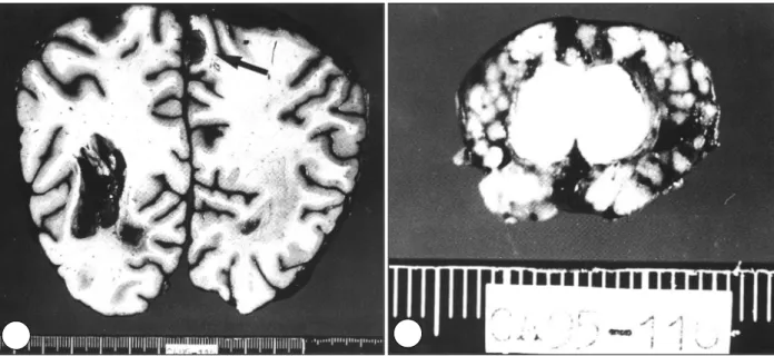 Fig. 3. A coronal section of the brain shows a right parietal parasagittal tumor mass(A, arrow)
