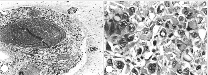 Fig. 4. Microscopically, pigmented and nonpigmented malignant melanoma cells are seen in the pia-arachnoid and around  the Virchow-Robin space(A, H &amp; E ×200)