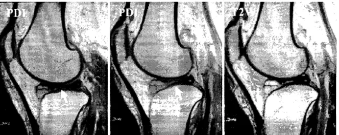 Fig.  6. Previous Saggital view of MRI on left knee showed complete discoid lateral meniscal cyst with horizontal tear.