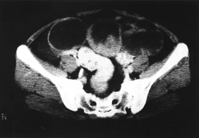 Fig. 2. Preoperative brain CT and MRI showing an well-enhancing mass on right fronto-parietal area with peritumoral brain edema