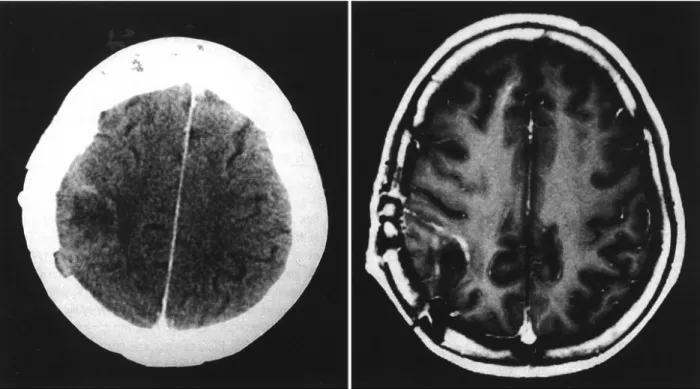 Fig. 4. Postoperative brain CT and MRI demonstrating postoperative changes on the previous tumor site without visible enhan- enhan-cing mass