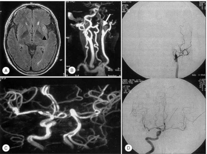 Fig. 2. A：Intermediate-weighted image showing a subtle high signal intensity in left basal ganglia(black arrow head)