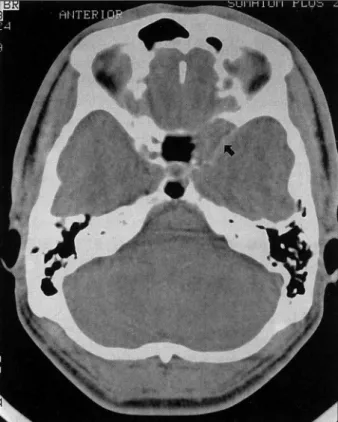 Fig. 1. Preopeative brain CT demonstrating a osteolytic lesion in the lesser wing of left sphenoid bone and a soft tissue mass(arrow)