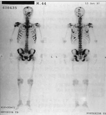 Fig. 4. Whole body bone scan demonstrating multiple hot uptake lesions in both shoulders, pelvis, ribs and skull