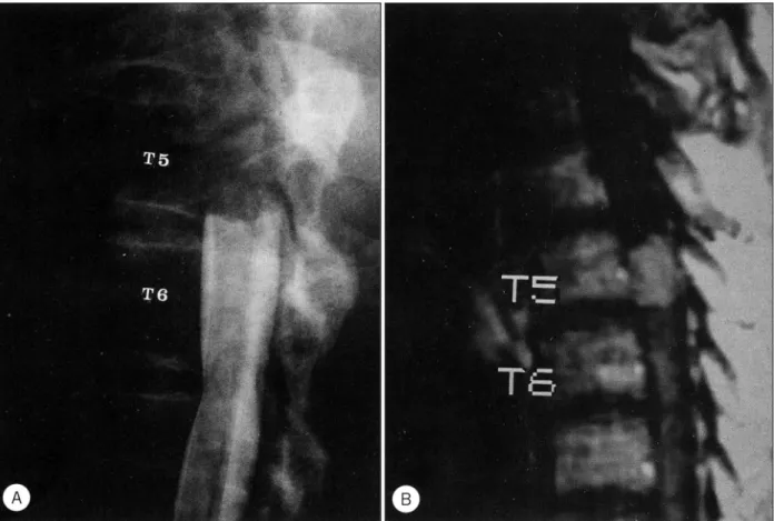 Fig. 1. A：Lateral view of thoracic myelography showing complete block of contrast column at the lower body level of T5