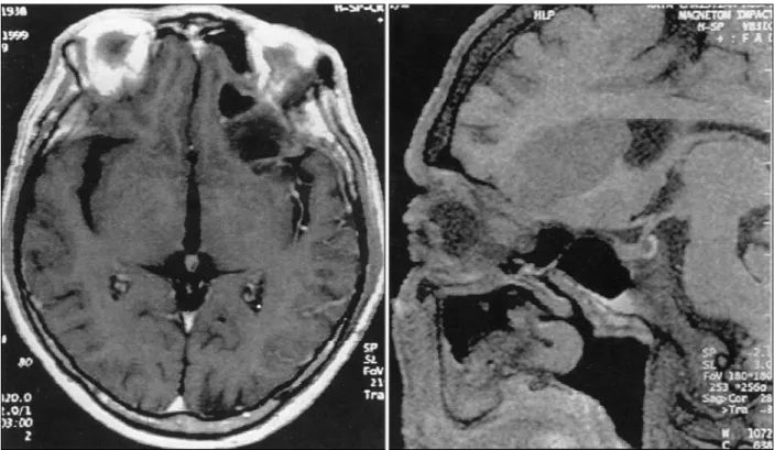 Fig. 1. A：Axial T1-weighted enhanced MR image obtained preoperatively revealing 3.5cm sized cystic lesion at the left basal  frontal lobe, which are enhanced peripherally