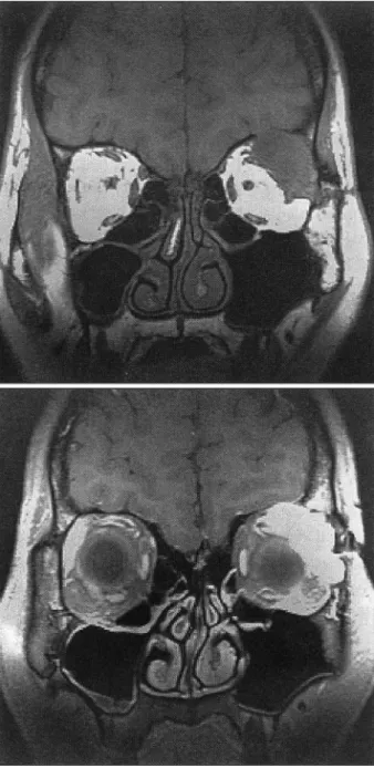 Fig. 3. Intraoperative photograph. Left：Exposure of intracra- intracra-nial compartment and orbital cavity after exenteration  and radical orbitectomy via orbitozygomatic approach