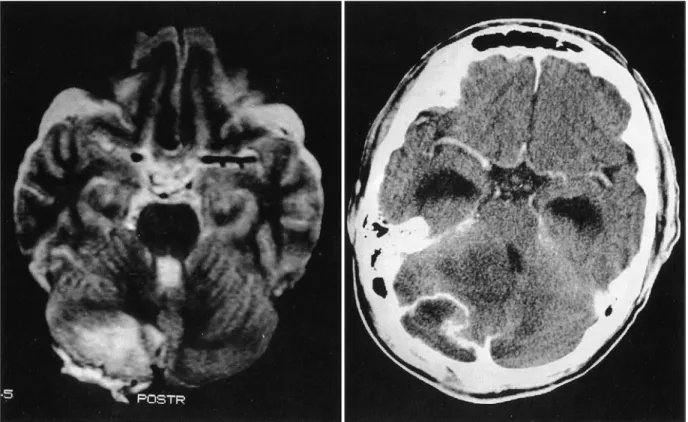 Fig. 3. Axial T2W1 MRI showing a lobulated cyst in the right cerebellum area(left). Contrast enhanced brain CT scan showing  enhancement of a cystic mass(right)