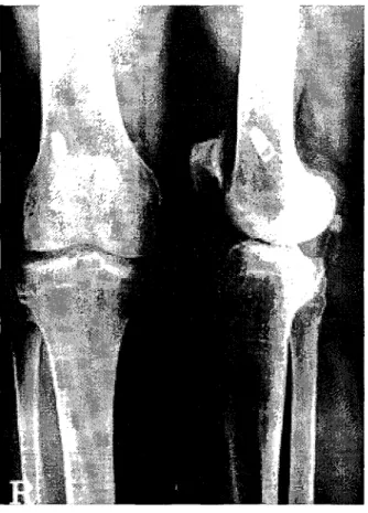 Fig. 3. Microscopic finding of the cyst wall shows synovial lin­