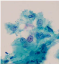 Fig.  1.  Normal  superficial  (eosinophilic)  and  intermediate  (basophilic)  cells  by  cytologic  finding  with  Pap  stain