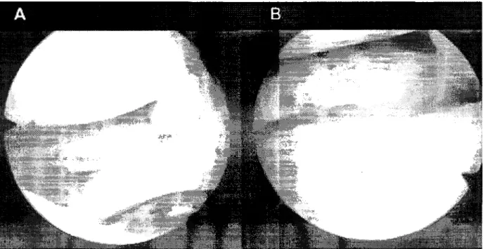 Fig. 2. (A) Arthroscopic findings of horizontal tear of the lateral meniscus.