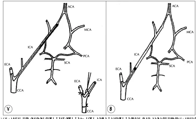 Fig. 1. A：Schematic representation of position of 4-0 nylon during occlusion of right middle cerebral artery