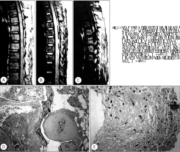 Fig. 1. The MRI and histopathologic findings of Case 2. A：T1 weighted imaging showing a focal segmental swelling of spinal  co-rd in T4-5 level