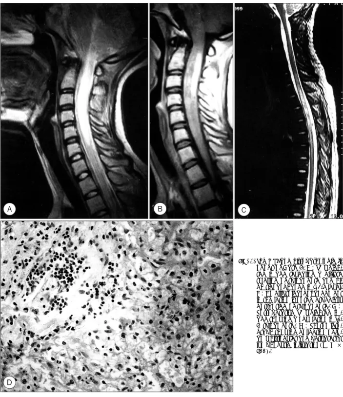 Fig. 2. The MRI and histopathologic fi- fi-ndngs of Case 5. A：T2  weigh-ted image revealing a diffuse  swelling of spinal cord and  hi-gh signal change in C2-6 level