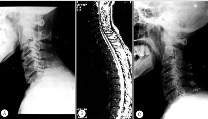 Fig. 4. Radiographs of the patient with cervical OPLL which was complicated by trauma