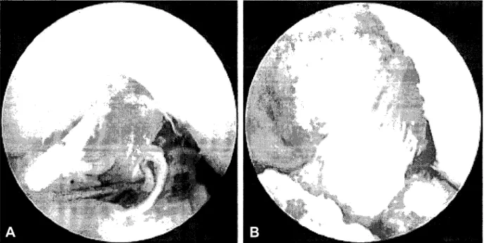 Fig.  1. The Arthroscopic  view thro 니gh  anterolateral  portal. A. Before ACL reconstr니 ction