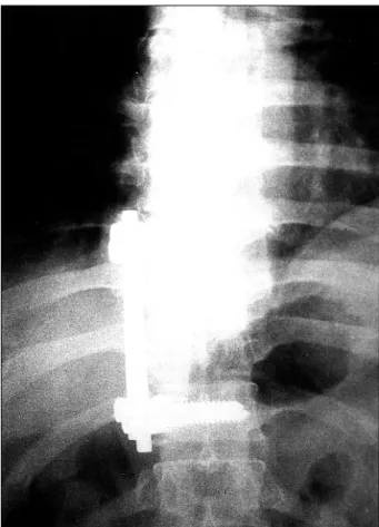 Fig. 4. Post-operative sagittal T1 W1 and T2 W1 demonstrating disappearance of spinal cord compression