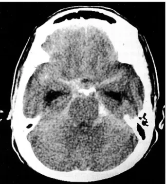 Fig. 1. Preoperative CT scan showing thick subarachnoid hemor- hemor-rhage at ambient, interpeduncular, and pontine cistern