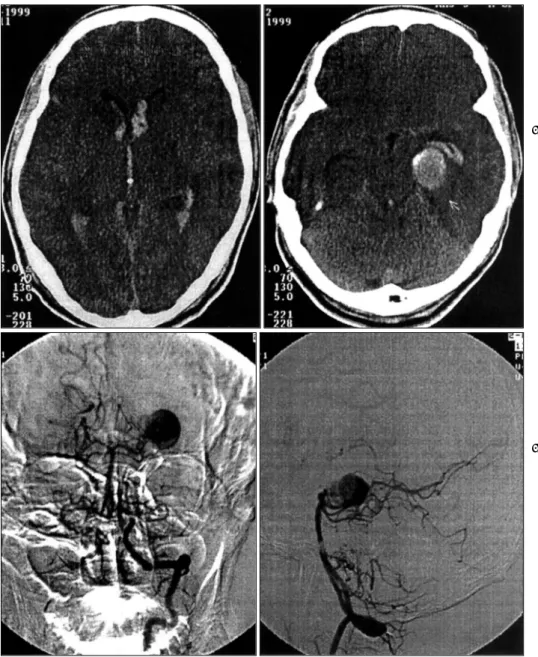 Fig. 1. Preoperative brain CT sh- sh-owing intraventricular  he-morrhage and round  cal-cified mass between the  brain stem and the  medi-al portion of the left  tem-poral lobe