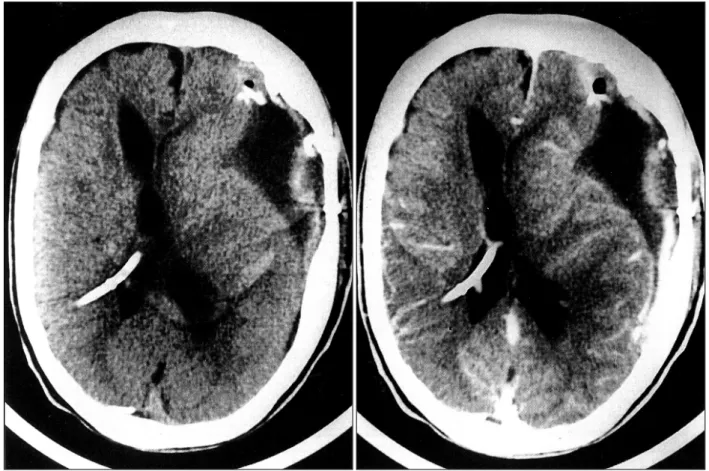 Fig. 3. Postoperative enhanced brain CT scan demonstrating reexpansion of the brain parenchyme with CSF filled cystic cavity and a small amount of residual calcification