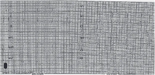 Fig. 1. Electrocardiogram measured in 2007. A biphasic T wave inversion is showed from precordial  lead V1 to 4.