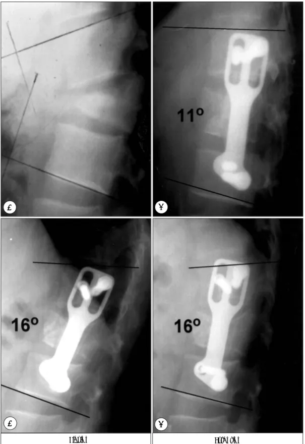 Fig. 3. L1 burst fracture with 3-column injury. A：Preoperative lateral plain film shows severe kyphotic deformity with 3-column injury