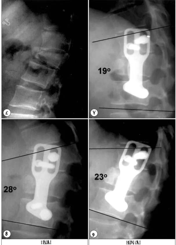 Fig. 4. L1 burst fracture. A：Initial lateral plain film shows kyphotic angulation. B：Immediate postoperative film revealing anterior  fusion with kyphotic angle 19° 