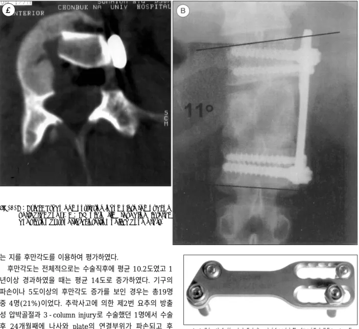 Fig. 5. A：Axial CT scan demonstrating incomplete removal of vertebral body. B： AP plain film revealing lateral angulation by superficial insertion of iliac bone graft