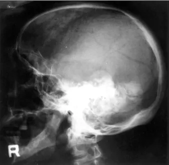 Fig. 1. Skull X-ray(lateral view) showing multiple, aggregated, calcified cystic shadows in the left temporo-occipital region, which mimic“soap-bubble” appearance