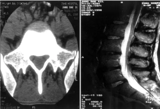 Fig. 1. Left；Lumbar spine CT showing normal findings. Right；T2 weighted images demonstrating high signal intradural contineous  lesion but difficult to identify the margin