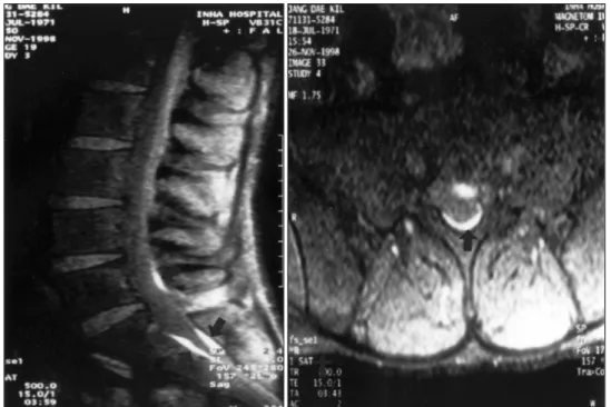 Fig. 3. Post-lumbar puncture fat suppression MRI showing minimally remained subdural hematoma(arrows)