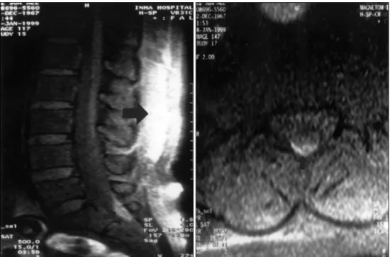 Fig. 5. Post-lumbar puncture fat suppression MRI showing remaining spinal subdural hematoma(small arrows) and spinal back mu- mu-scle signal is increased(large arrow) due to spinal subdural hematoma leakage via puncture site