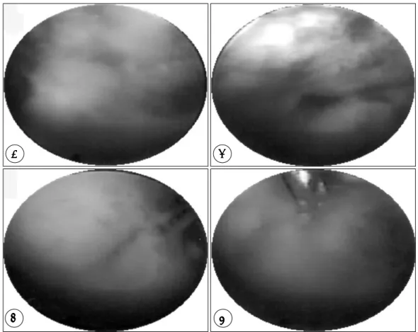 Fig. 3. Intraoperative view(1). A：Whitish pus was encountered first after endoscope insertion