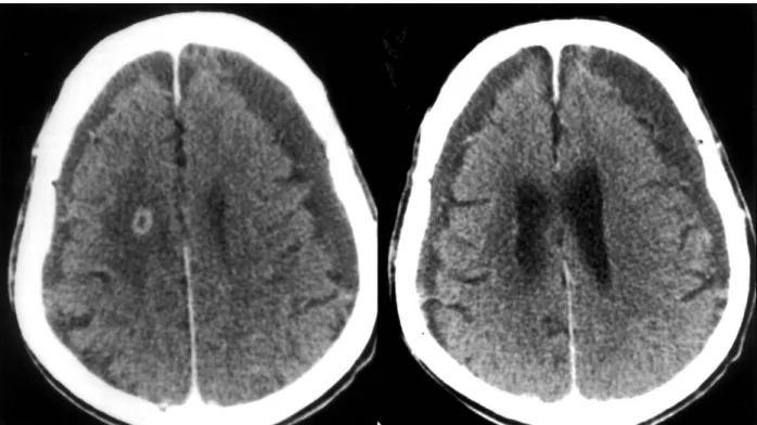 Fig. 5. Posteoperative CT scan, which was done at the next day, showing near complete removal of abscess