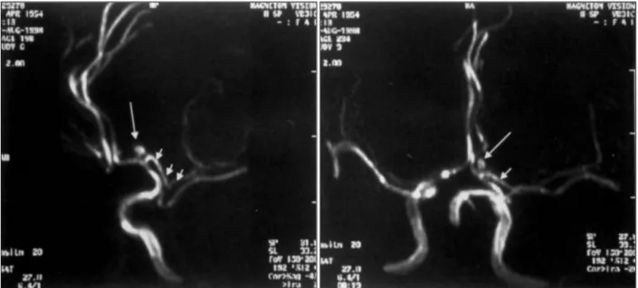 Fig. 1. Magnetic resonance angiography demonstrating the left accessory middle cerebral artery(short arrow) arising from the  distal part of the anterior cerebral artery with an aneurysm(long arrow) at its origin