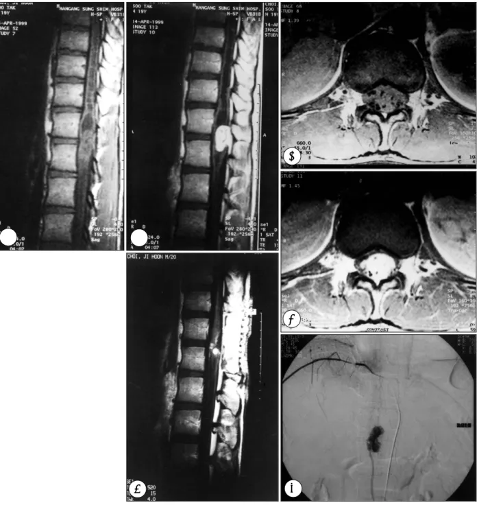 Fig. 1. A：T1-weighted MR image showing mass lesion and syrinx in the spinal cord. B：Gd-DTPA enhanced image showing remar- remar-kably enhanced mass