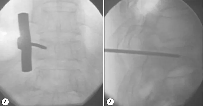 Fig. 1. The 11G biopsy needle(Jamshidi) was advanced into the pedicle by the percutaneous approach