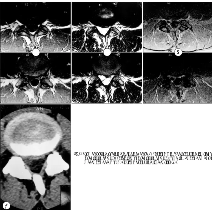 Fig. 1. Lumbar spine radiologic finding(case 3). Axial MR images showing iso-signal intensity in T1WI(A), high signal intensity in T2WI(B), and rim enhancement in Gd-enhanced MR(C)