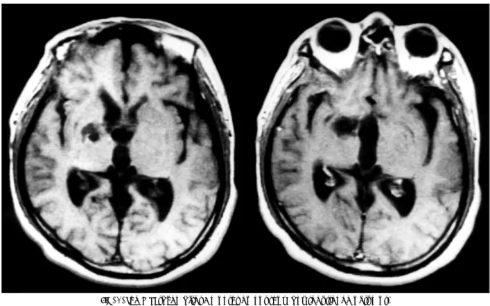 Fig. 4. The MRI taken after 7 months do not show any recurrence of tumor. 