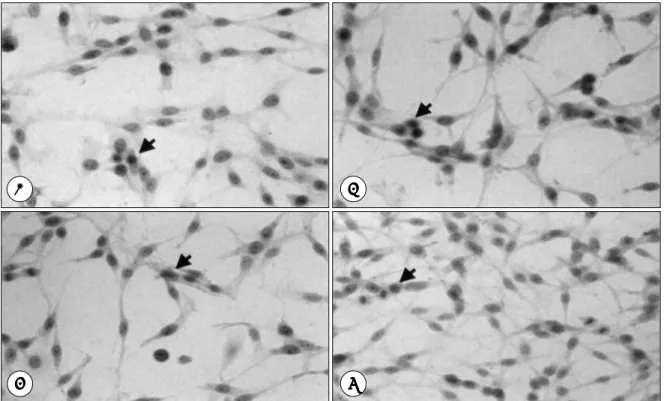Fig. 1. Photographs of U-251 MG cell line that stained by immunoperoxidase after 24 hours from cytokine treatment, ICAM-1  antibody positive cells showing diffuse brownish cytoplasmic staining(arrow)
