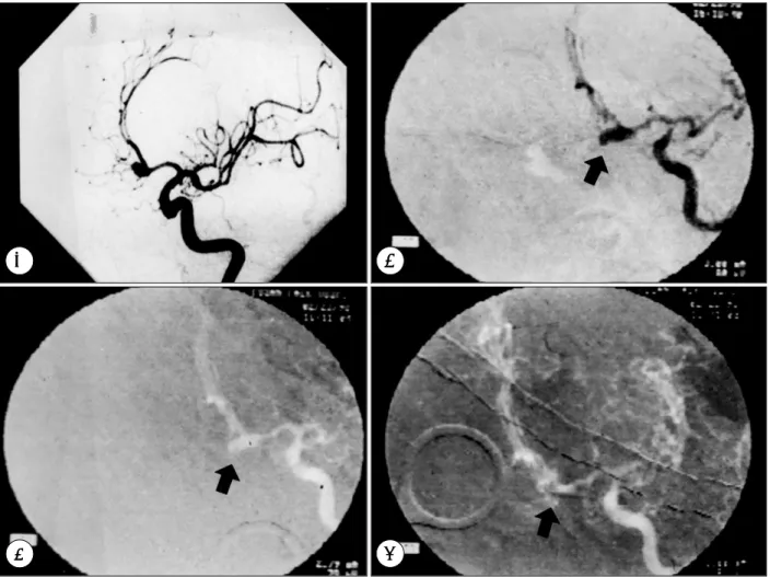 Fig. 2. Angiograms obtained in case requiring clip adjustment. A：Preoperative angiogram obtained in a 51-year old women  who presented with headache and deterioration of mentality caused by ruptured anterior communicating artery aneurysm