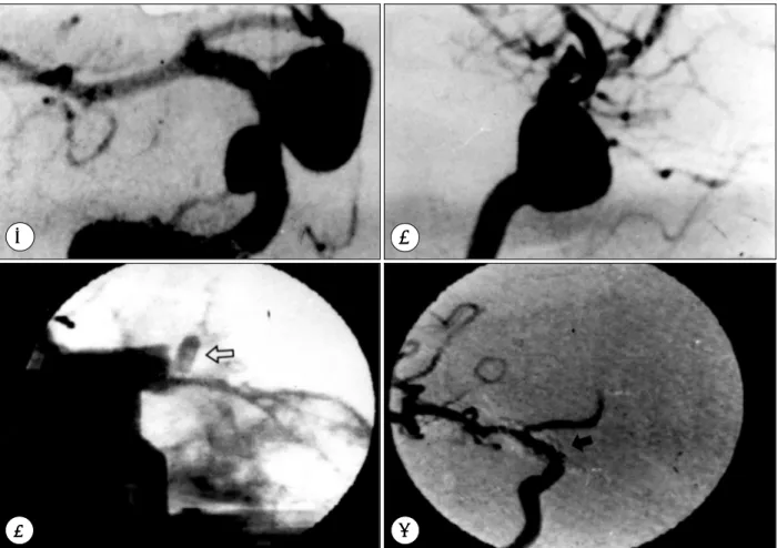 Fig. 5. A：Preoperative right caroid angiogram of a patient with a large ophthalmic artery aneurysm(A-P view)