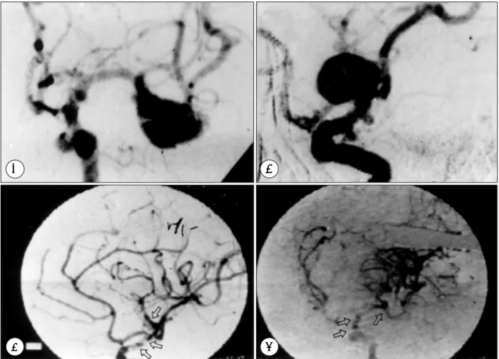 Fig. 6. Left carotid angiographic finding. A &amp; B：Preoperative angiography was revealed that one large aneurysm(at  bifurcation of MCA) and two small aneurysms(anterior choroidal a